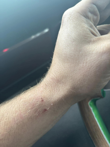 Un camionneur victime d'une altercation violente dans la cour d'un motel à Sherbrooke, capturé sur vidéo et devenu viral sur les réseaux sociaux, photo de la morsure.
